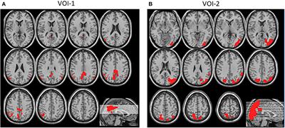 Differentiating Mild Cognitive Impairment, Alzheimer's Disease, and Dementia With Lewy Bodies Using Cingulate Island Sign on Perfusion IMP-SPECT